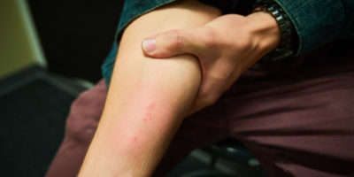 Person holding out their arm with a bug bite on it